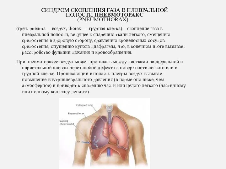 СИНДРОМ СКОПЛЕНИЯ ГАЗА В ПЛЕВРАЛЬНОЙ ПОЛОСТИ ПНЕВМОТОРАКС (PNEUMOTHORAX) - (греч.