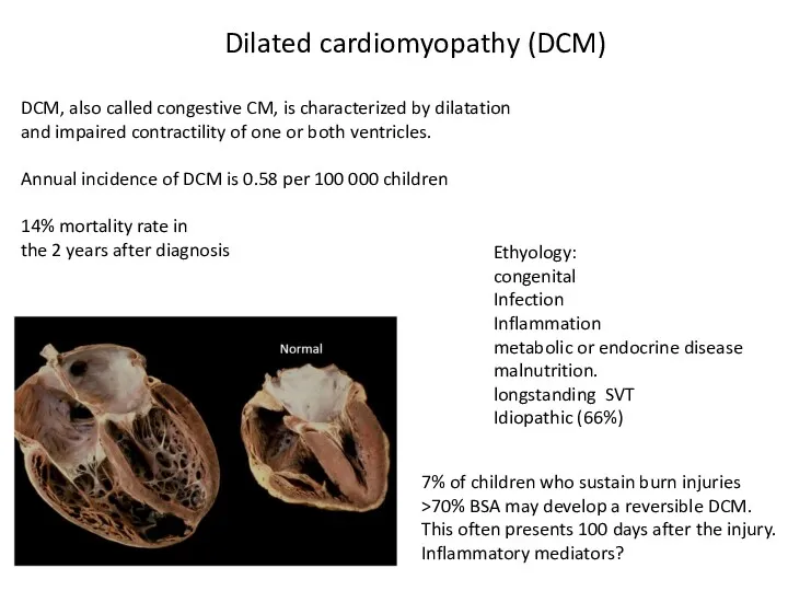 Dilated cardiomyopathy (DCM) DCM, also called congestive CM, is characterized