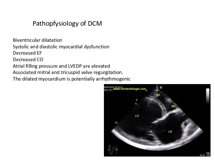 Pathopfysiology of DCM Biventricular dilatation Systolic and diastolic myocardial dysfunction