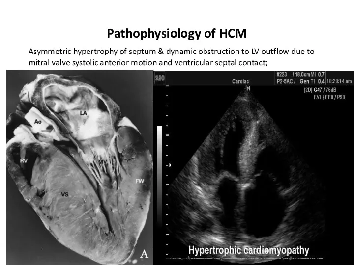 Pathophysiology of HCM Asymmetric hypertrophy of septum & dynamic obstruction
