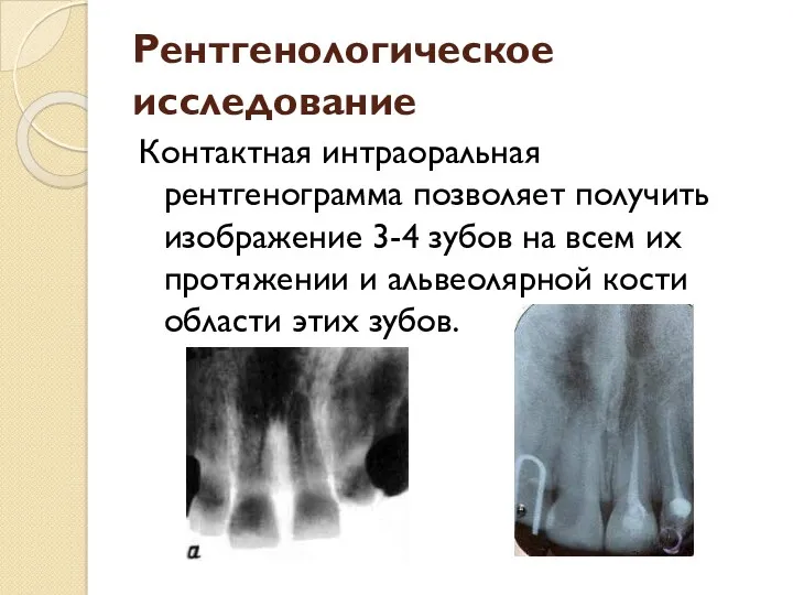 Рентгенологическое исследование Контактная интраоральная рентгенограмма позволяет получить изображение 3-4 зубов