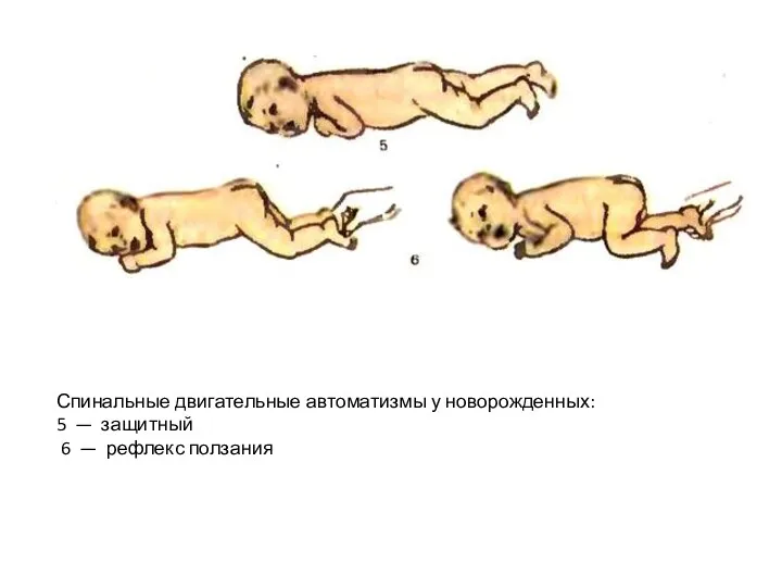 Спинальные двигательные автоматизмы у новорожденных: 5 — защитный 6 — рефлекс ползания