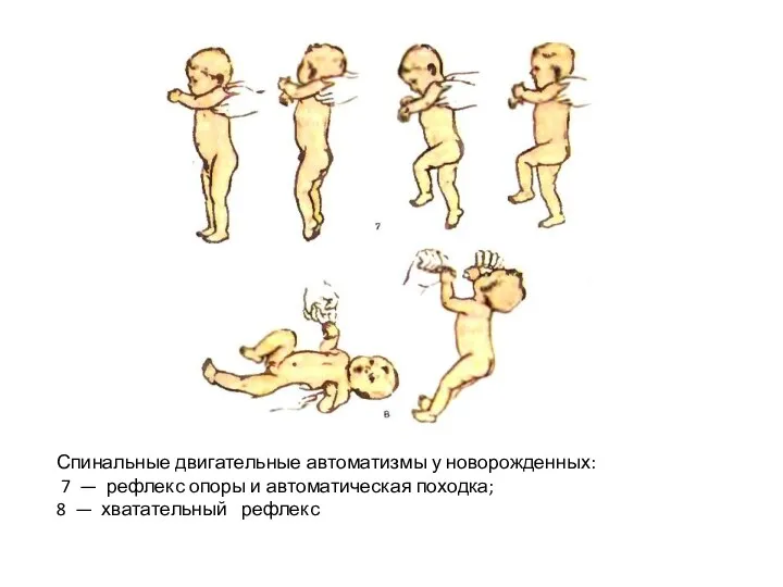 Спинальные двигательные автоматизмы у новорожденных: 7 — рефлекс опоры и автоматическая походка; 8 — хватательный рефлекс