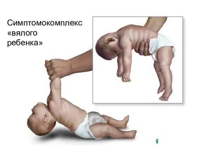 Симптомокомплекс «вялого ребенка»
