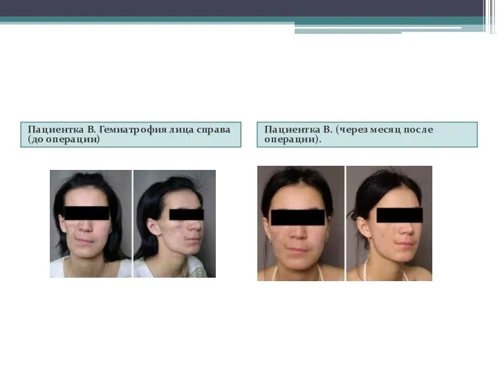 Пациентка В. Гемиатрофия лица справа (до операции) Пациентка В. (через месяц после операции).