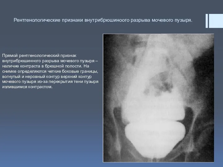 Рентгенологические признаки внутрибрюшиноого разрыва мочевого пузыря. Прямой рентгенологический признак внутрибрюшинного