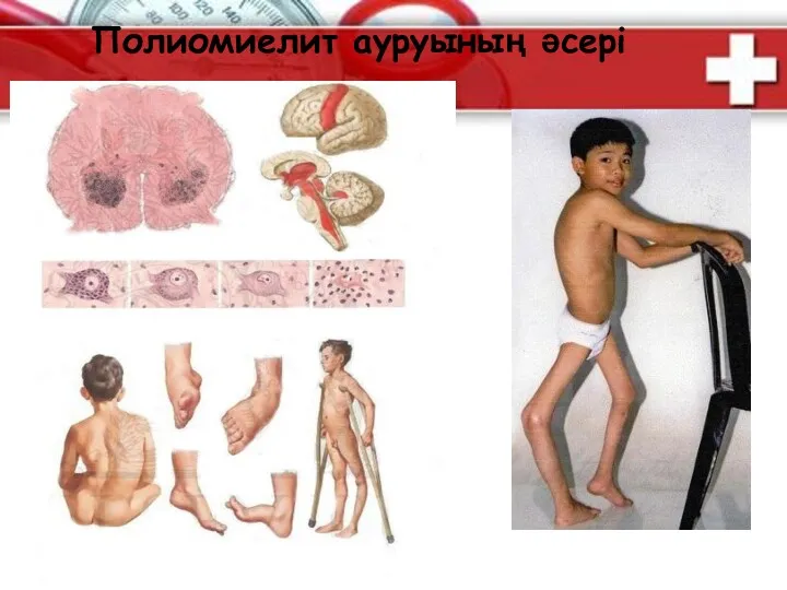 Полиомиелит ауруының әсері