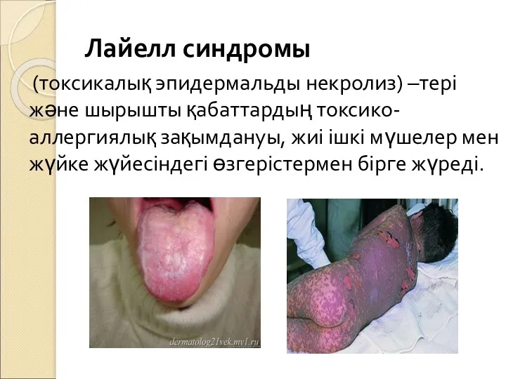 Лайелл синдромы (токсикалық эпидермальды некролиз) –тері және шырышты қабаттардың токсико-аллергиялық зақымдануы, жиі ішкі