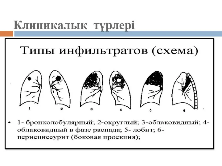 Клиникалық түрлері Өкпенің инфильтратты туберкулезі