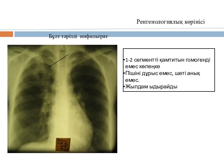 Ренгенологиялық көрінісі Бұлт тәрізді инфильтрат 1-2 сегментті қамтитын гомогенді емес