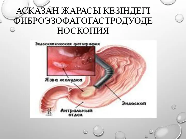 АСҚАЗАН ЖАРАСЫ КЕЗІНДЕГІ ФИБРОЭЗОФАГОГАСТРОДУОДЕНОСКОПИЯ