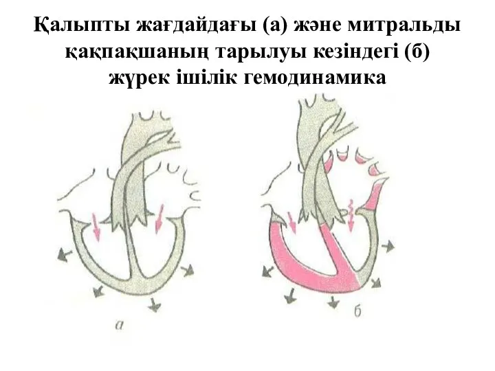Қалыпты жағдайдағы (а) және митральды қақпақшаның тарылуы кезіндегі (б) жүрек ішілік гемодинамика