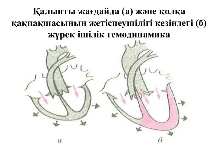 Қалыпты жағдайда (а) және қолқа қақпақшасының жетіспеушілігі кезіндегі (б) жүрек ішілік гемодинамика