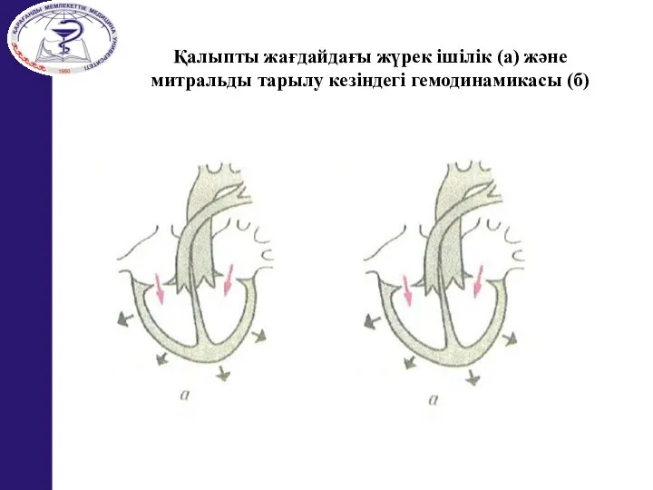 Қалыпты жағдайдағы жүрек ішілік (а) және митральды тарылу кезіндегі гемодинамикасы (б)