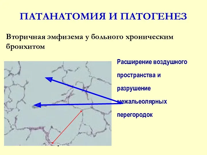 ПАТАНАТОМИЯ И ПАТОГЕНЕЗ Вторичная эмфизема у больного хроническим бронхитом Расширение воздушного пространства и разрушение межальеолярных перегородок