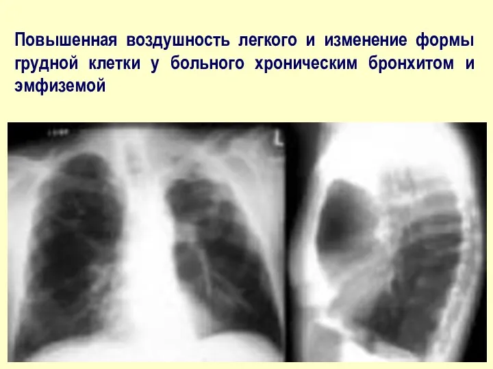 Повышенная воздушность легкого и изменение формы грудной клетки у больного хроническим бронхитом и эмфиземой