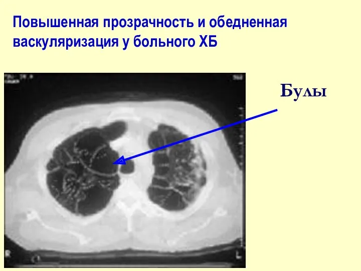 Булы Повышенная прозрачность и обедненная васкуляризация у больного ХБ