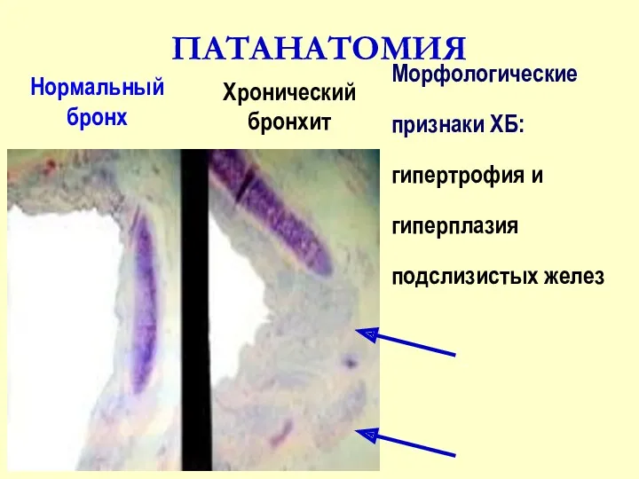 ПАТАНАТОМИЯ Нормальный бронх Хронический бронхит Морфологические признаки ХБ: гипертрофия и гиперплазия подслизистых желез