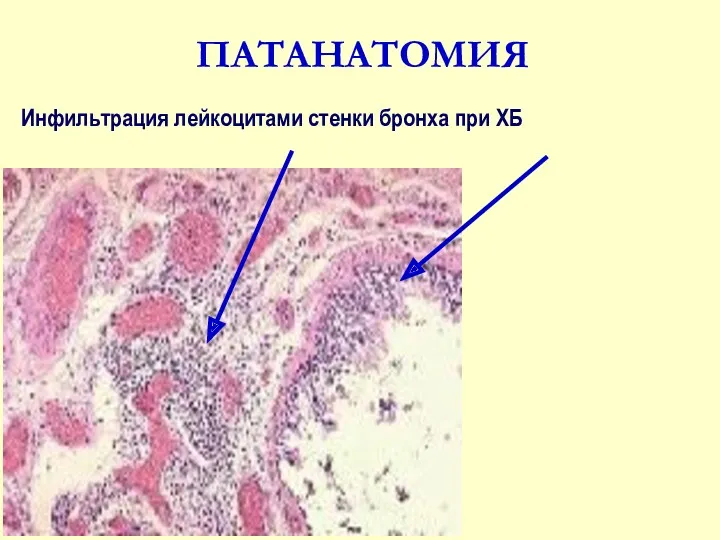 ПАТАНАТОМИЯ Инфильтрация лейкоцитами стенки бронха при ХБ