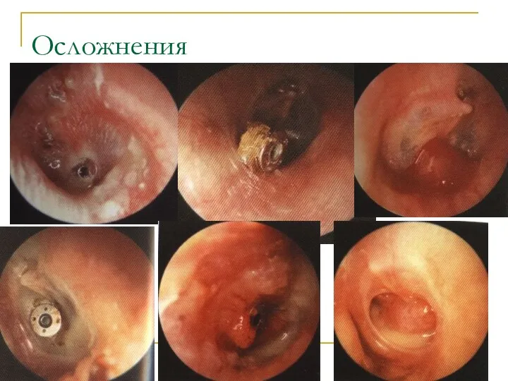 Осложнения