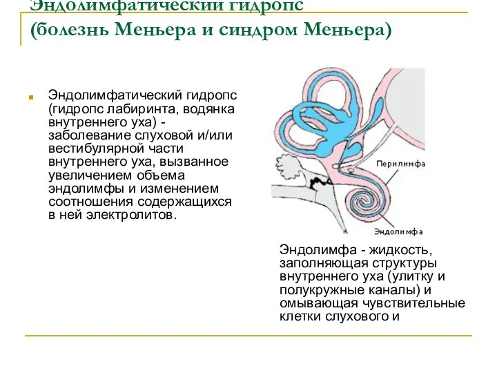 Эндолимфатический гидропс (болезнь Меньера и синдром Меньера) Эндолимфатический гидропс (гидропс