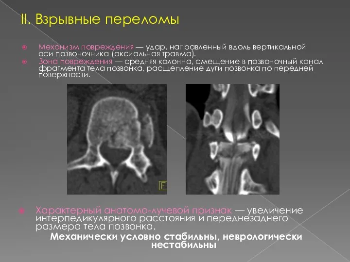 II. Взрывные переломы Механизм повреждения — удар, направленный вдоль вертикальной