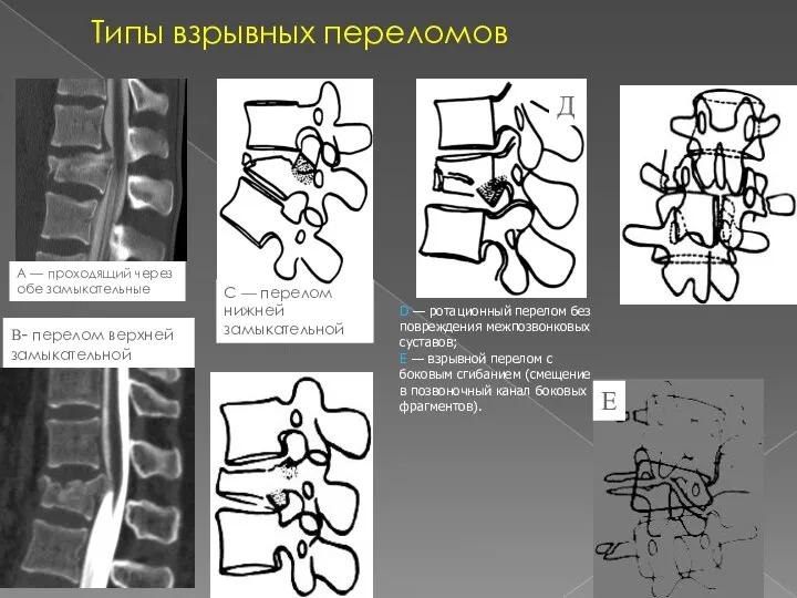 А — проходящий через обе замыкательные пластинки; В- перелом верхней