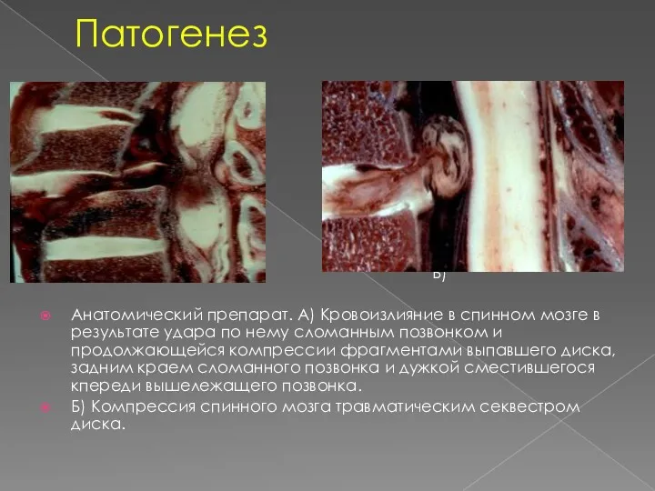 Патогенез А) Б) Анатомический препарат. А) Кровоизлияние в спинном мозге