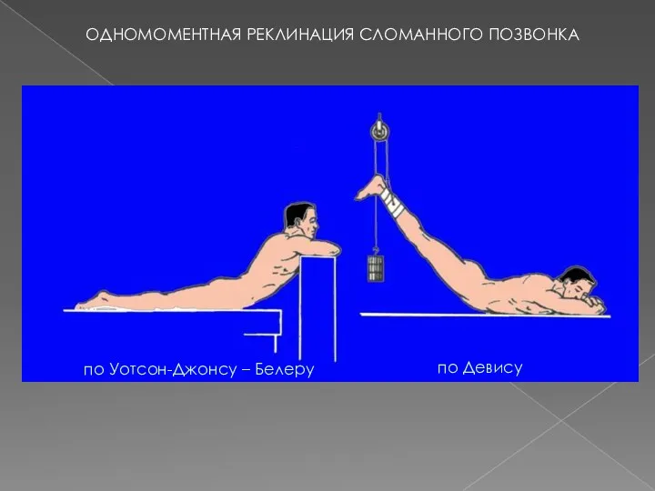 ОДНОМОМЕНТНАЯ РЕКЛИНАЦИЯ СЛОМАННОГО ПОЗВОНКА по Уотсон-Джонсу – Белеру по Девису