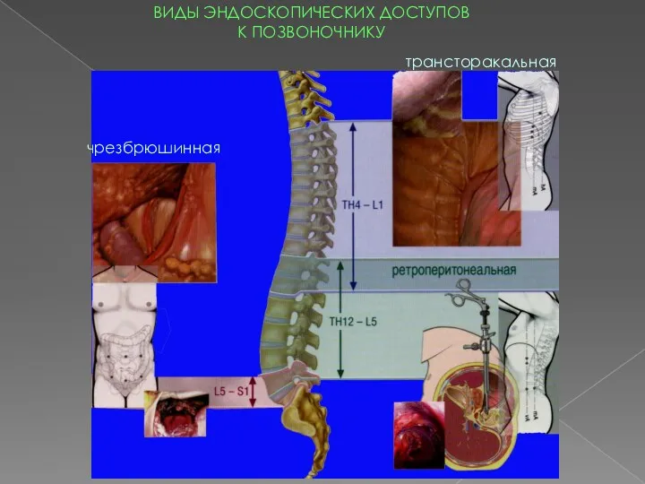 чрезбрюшинная трансторакальная ВИДЫ ЭНДОСКОПИЧЕСКИХ ДОСТУПОВ К ПОЗВОНОЧНИКУ