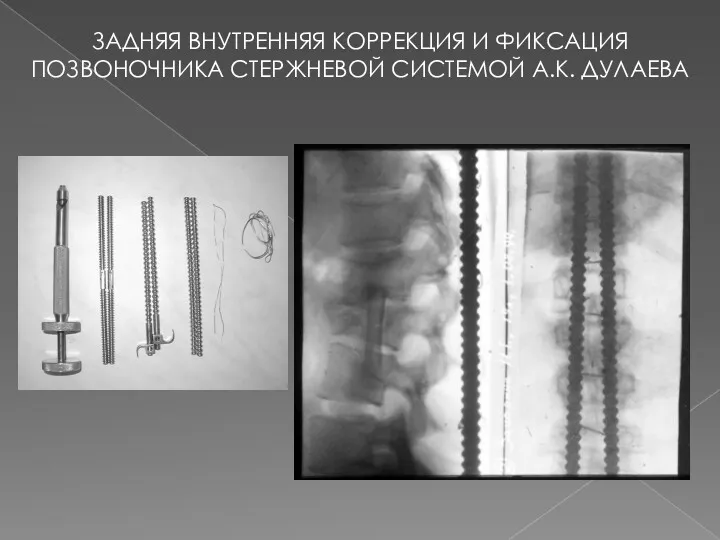 ЗАДНЯЯ ВНУТРЕННЯЯ КОРРЕКЦИЯ И ФИКСАЦИЯ ПОЗВОНОЧНИКА СТЕРЖНЕВОЙ СИСТЕМОЙ А.К. ДУЛАЕВА