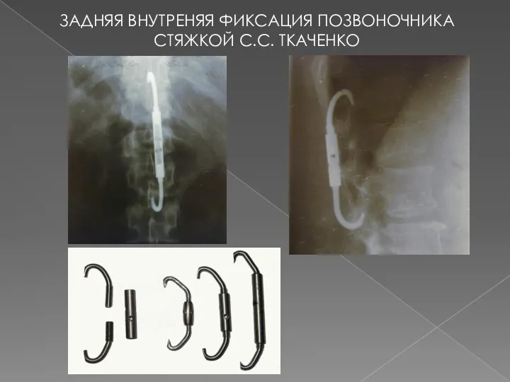 ЗАДНЯЯ ВНУТРЕНЯЯ ФИКСАЦИЯ ПОЗВОНОЧНИКА СТЯЖКОЙ С.С. ТКАЧЕНКО