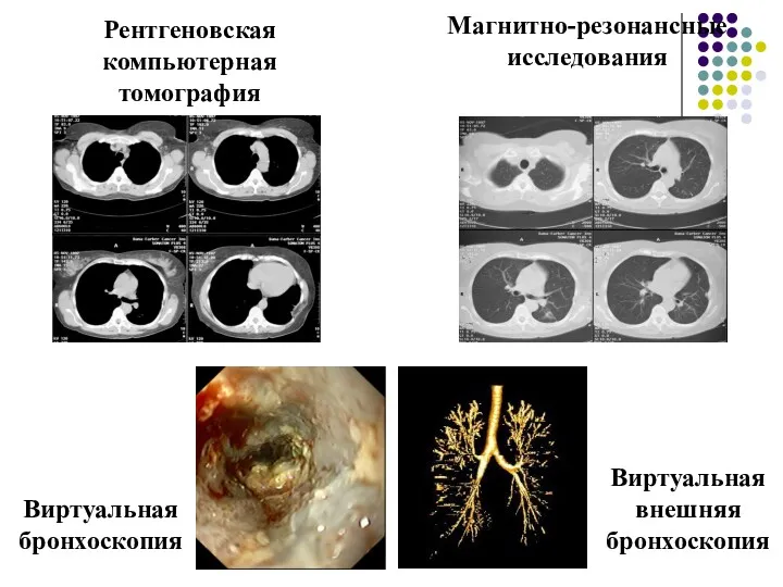 Рентгеновская компьютерная томография Магнитно-резонансные исследования Виртуальная внешняя бронхоскопия Виртуальная бронхоскопия