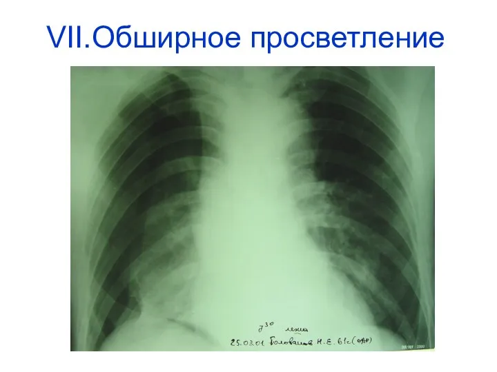 VII.Обширное просветление