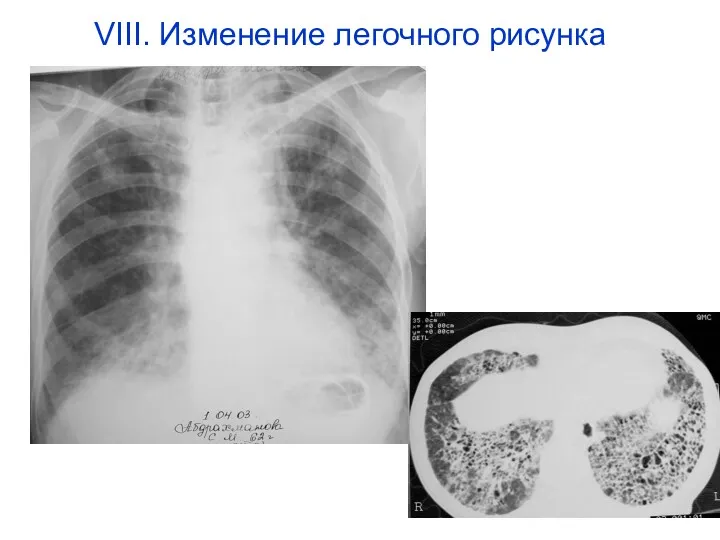 VIII. Изменение легочного рисунка