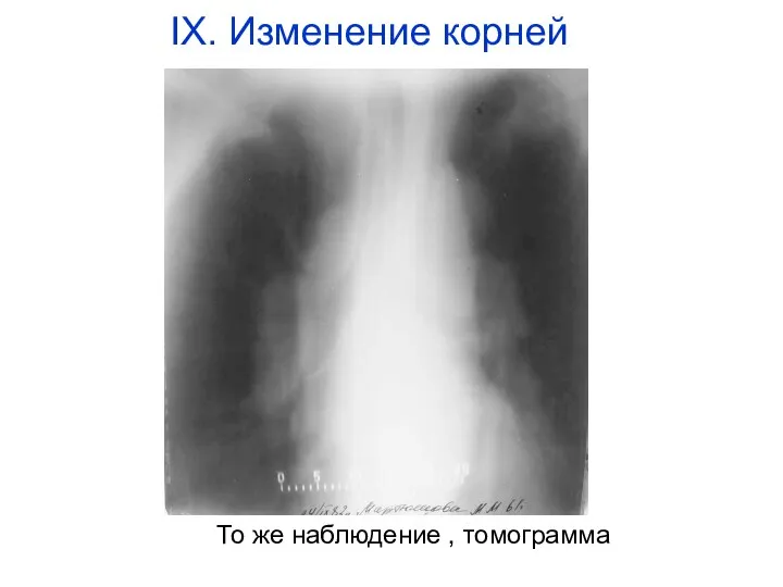 То же наблюдение , томограмма IX. Изменение корней