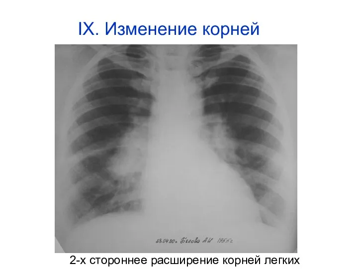 2-х стороннее расширение корней легких IX. Изменение корней