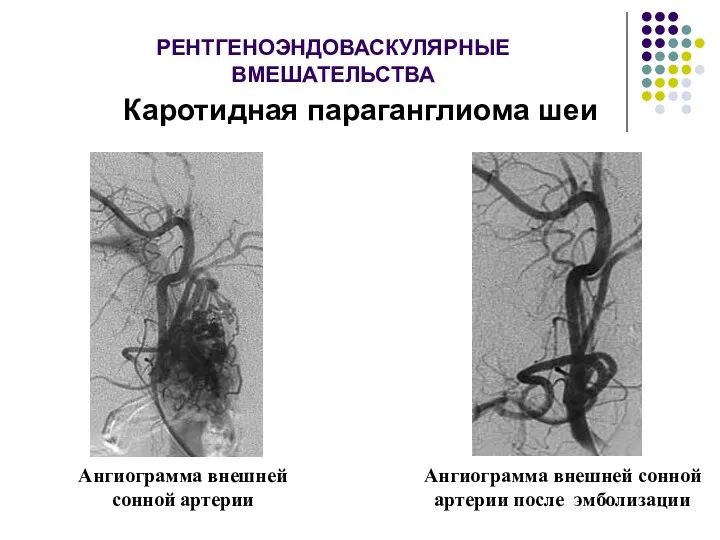 РЕНТГЕНОЭНДОВАСКУЛЯРНЫЕ ВМЕШАТЕЛЬСТВА Каротидная параганглиома шеи Ангиограмма внешней сонной артерии Ангиограмма внешней сонной артерии после эмболизации