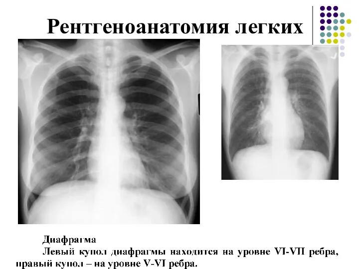 Рентгеноанатомия легких