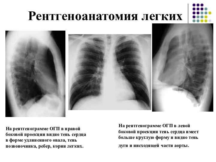 Рентгеноанатомия легких На рентгенограмме ОГП в левой боковой проекции тень