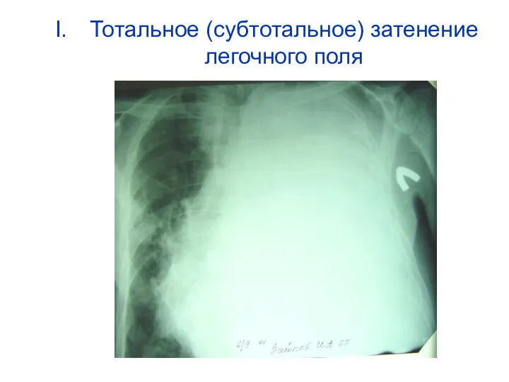 Тотальное (субтотальное) затенение легочного поля