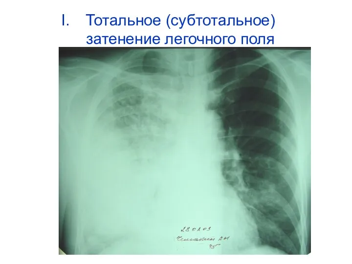 Тотальное (субтотальное) затенение легочного поля