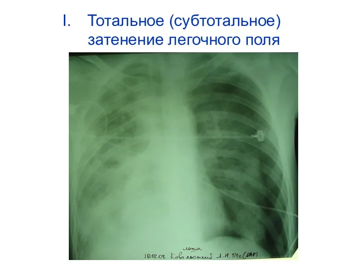 Тотальное (субтотальное) затенение легочного поля