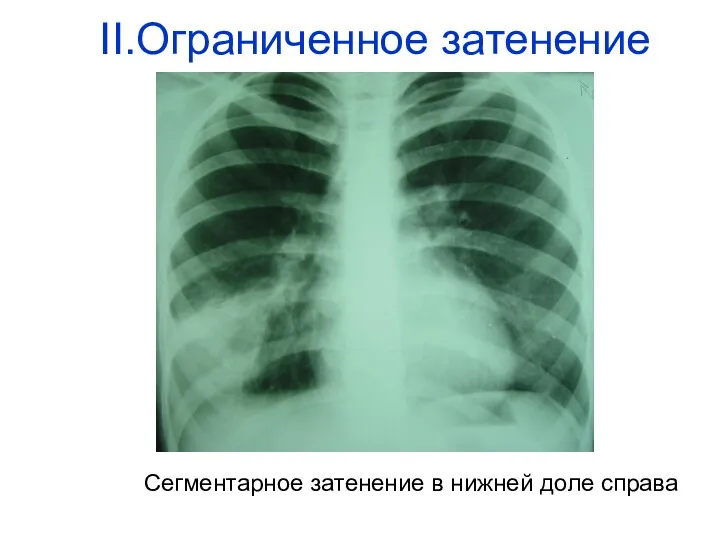 Сегментарное затенение в нижней доле справа II.Ограниченное затенение