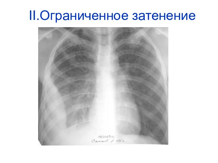 II.Ограниченное затенение