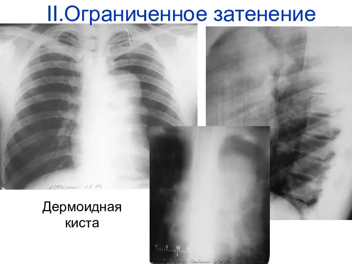 Дермоидная киста II.Ограниченное затенение