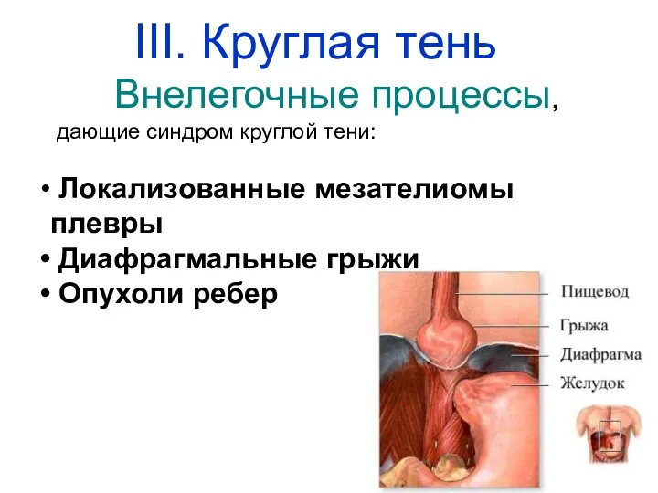 Внелегочные процессы, дающие синдром круглой тени: Локализованные мезателиомы плевры Диафрагмальные грыжи Опухоли ребер III. Круглая тень