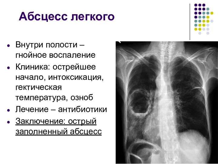 Абсцесс легкого Внутри полости – гнойное воспаление Клиника: острейшее начало,