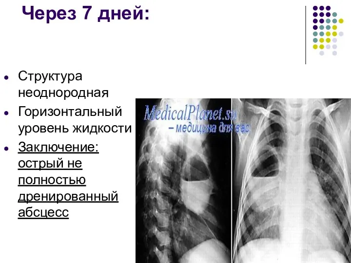 Через 7 дней: Структура неоднородная Горизонтальный уровень жидкости Заключение: острый не полностью дренированный абсцесс