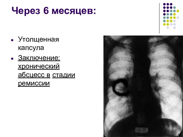 Через 6 месяцев: Утолщенная капсула Заключение: хронический абсцесс в стадии ремиссии